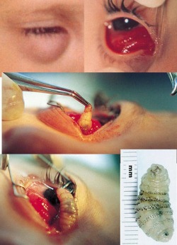 &ldquo;WORM&rdquo; removed from woman&rsquo;s eye. &ldquo;Anterior Orbital Myiasis caused by Human Botfly,&rdquo; published in the July 2000 number of the Archives of Ophthalmology, a journal of the American Medical Association.