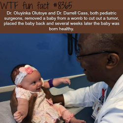 wtf-fun-factss:  Doctor removed a baby from the womb and placed the baby back..- WTF fun facts