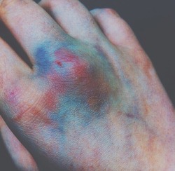 grungexteenx:  Bruises fascinate me lol idk 