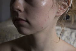 femme-cutie:  I love my acne kissed skin and rosacea tinted cheeks.I love my oily complexion that shines bright always. I love my scoliosis crooked shoulders. I love my freckles and moles that become more abundant as I age. I love my fucking hairy