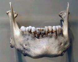 congenitaldisease:This image showing dental work on a mummy from ancient Egypt is evidence of ancient dentistry. Archaeologists believe this mummy was from around 200 BCE.