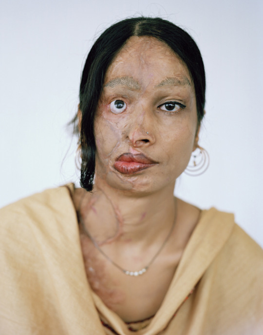 Muslim women acid attacks