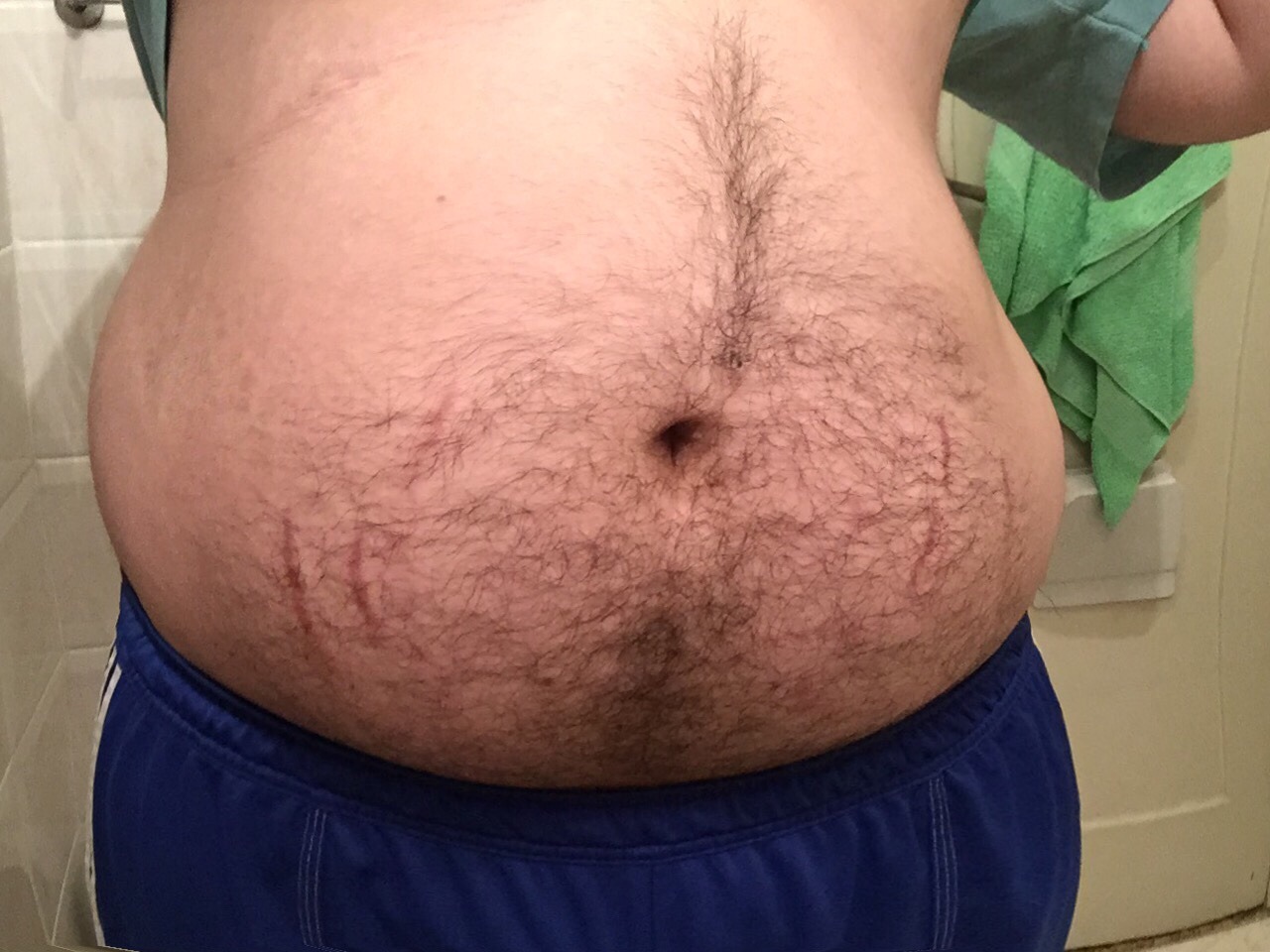 Belly stretch marks porn