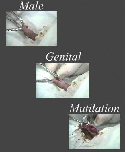 Female genital mutilation before and after
