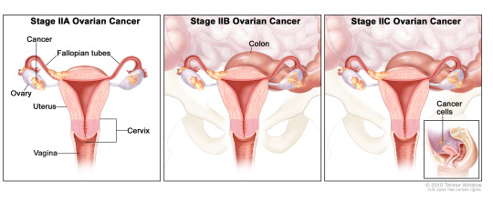 Ovarian Cancer Stages 