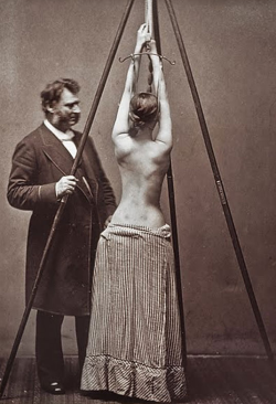 Scoliosis treatment by Lewis Sayre