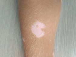 diary-of-a-chinese-kid:  One of my friend’s vitiligo spots looks like Pacman