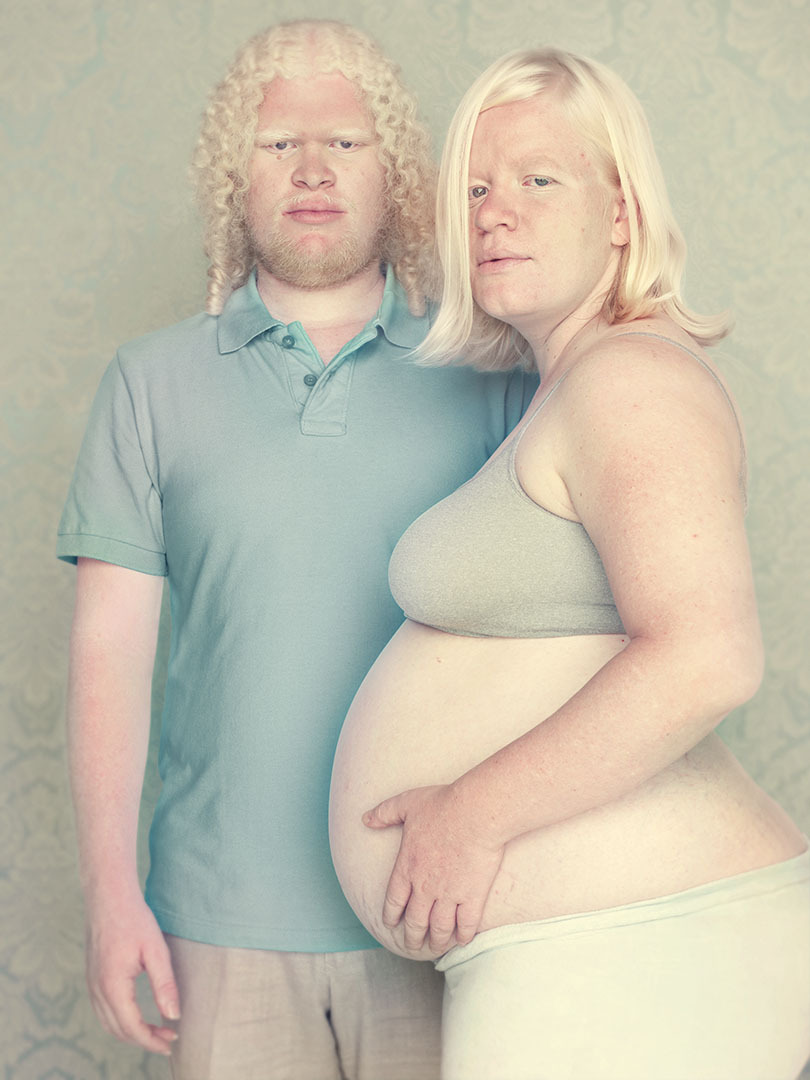 Albino person hot pics