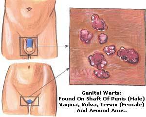 Genital warts on penis