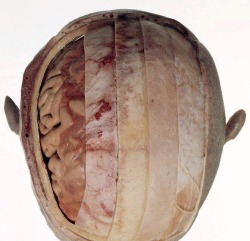 (From right to left): Scalp - Periosteum - Bone - Dura Mater - Arachnoid Mater - Pia Mater - Brain Tissue