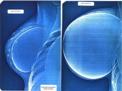praxis-erziehungsfragen:  boobjobaddict:  My kind of before and after pic! I’d love to see more x-rays of massive implants :)  Reblog if you agree!  Kleiner Fortschritt