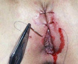 pussymodsgaloreBDSM pain games. Pussy being sewn shut. Chastity piercing.