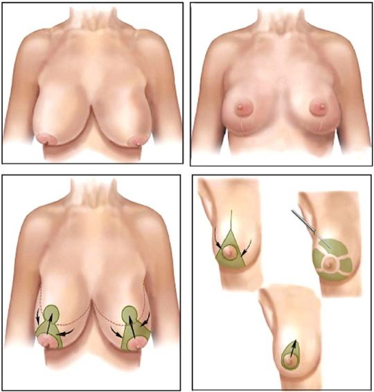 No breast reduction