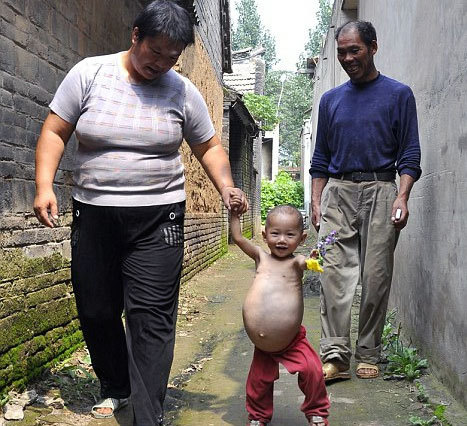 Boy with twin growing out of stomach