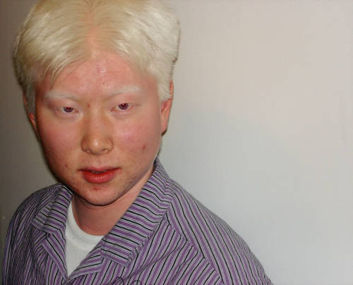 Albino person