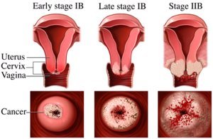 Cervical cancer stages matures porn
