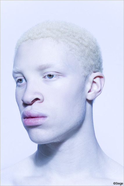 Albino person