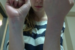solitudinous:  I don’t know if you guys can see that well but those are the red marks on my wrists for being handcuffed for three straight hours today, with my hands twisted unnaturally behind my back.  I decided to go to the wall street occupation