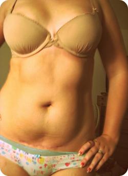 sexuallysexysex:  Sorry for the bonerkill guys.This is my body. Postpartum.Gotta nifty little c-section scar there. Hi.  psh.. scar makes it look sexier 