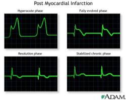 rambling-medic:  How do doctors look at ECGs and determine a patient has had a heart attack in the past? Well there is a pattern of evolution of a myocardial infarction seen on an ECG. A sign of an old infarct is the presence of pathological Q waves.