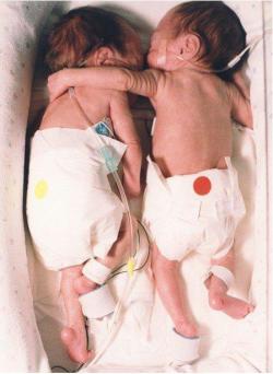  Esta fotografia é de um artigo intitulado “O abraço mágico” e foi publicado na NewsWeek. O artigo descreve detalhadamente a primeira semana de vida de dois bebês gêmeos. Cada um deles estava na sua incubadora e um tinha uma esperança de vida