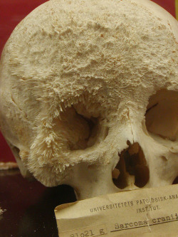 durianseeds:  Bone cancer on a human skull. 