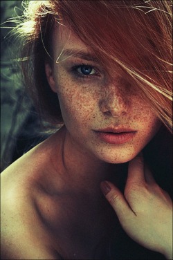 Freckles.