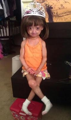  Esta é Adalia Rosa. Ela tem 5 anos e tem síndrome de progeria, Ela é tão linda e surpreendente, e honestamente merece um reblog aqui. mas se você não pode ter isso em seu blog porque ele vai fazê-lo parecer “feio”, então eu sinceramente não