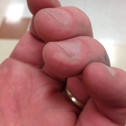 Just pinched my fingers in a shopping cart. Blister is a-rising&rsquo;! Hurts. (Taken with Instagram)