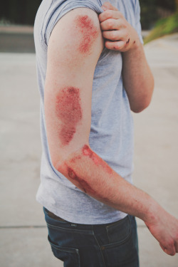 edwardshair:  fell off my skateboard the other day, bounced my head off the asphalt and scraped myself up pretty bad. don’t be an idiot; wear some kind of protective gear. also: pretty serious farmer’s tan. 